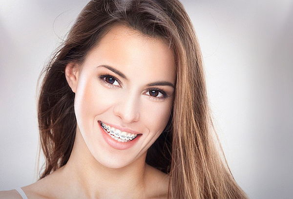 Instalación Brackets y Más en Instituto de estética Dental