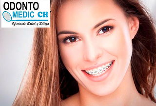 Instalación de Brackets Estéticos o Metálicos, Providencia
