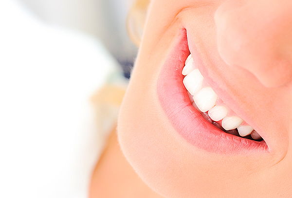 Fluorización Dental con Cubetas