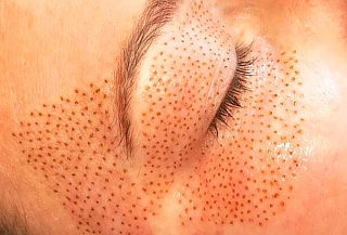 Nuevo! Fibroblast o Plasma Pen en Providencia