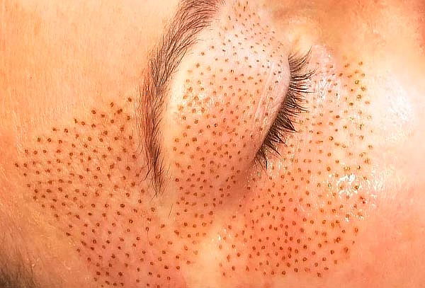 Nuevo! Fibroblast o Plasma Pen en Providencia