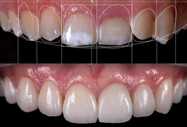 Diseño de Sonrisa: 6 Carillas Dentales Estéticas