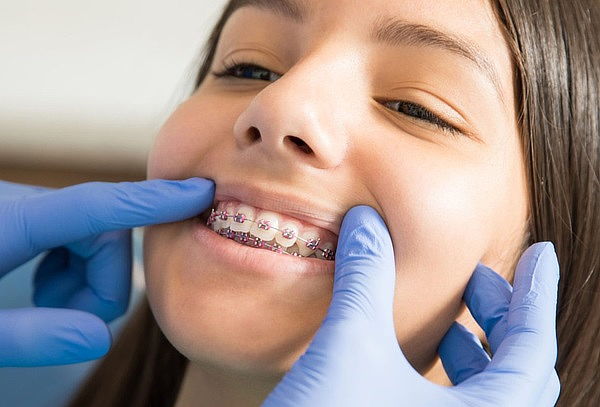 Instalación de Ortodoncia con Brackets Metálicos (Frenillos)