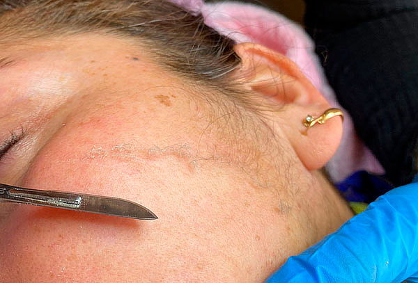 Dermaplaning + Fototerapia + Bienvenida en Body Stetic