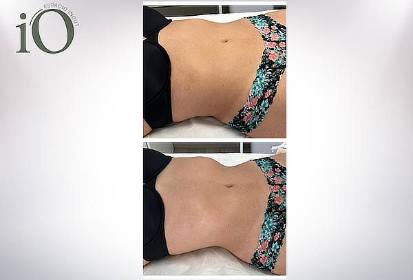Masaje Detox, Desinflama y Equilibra tu Cuerpo en InOut