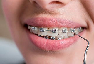 Instalación de Ortodoncia (Brackets Metálicos) 