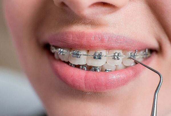 Instalación de Ortodoncia (Brackets Metálicos) 