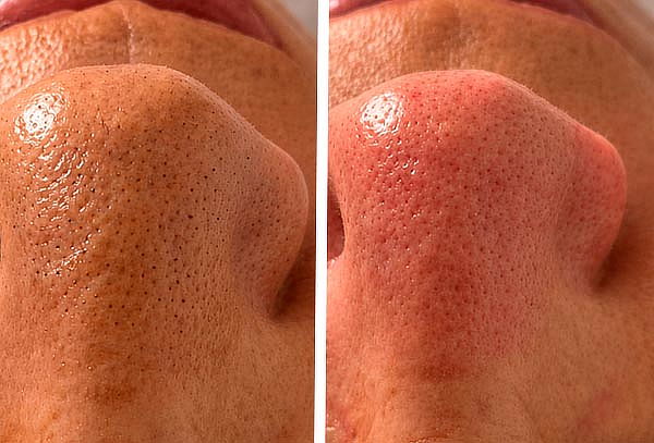 Limpieza Facial Profunda + Regalo de Cortesía