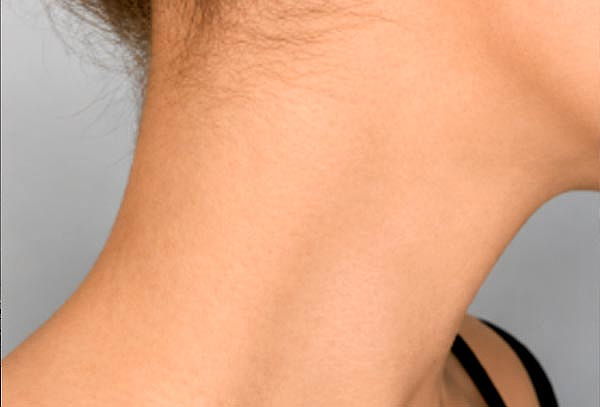 Retiro de Acrocordones de Forma Segura y Profesional
