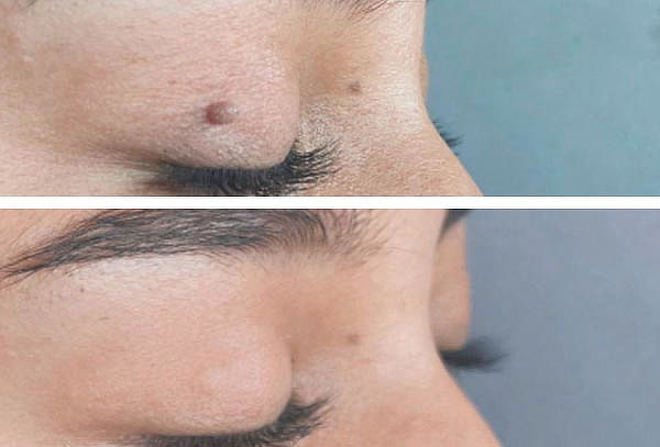 Retiro de Acrocordones de Forma Segura y Profesional