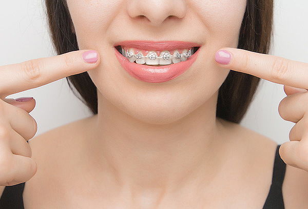 Gift Card Instalación de Brackets Metálicos en Providencia