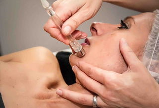 Limpieza facial profunda con Fotototera Microdermoabrasión 