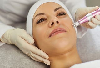Mesoterapia facial - Microneedling