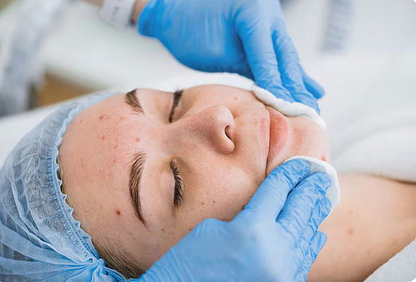 Limpieza facial premium especial para pieles con acné 