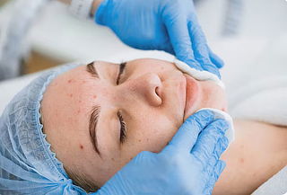 Limpieza facial premium especial para pieles con acné 