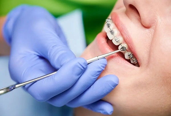 Retiro de Ortodoncia + Limpieza dental PRO + Contención 