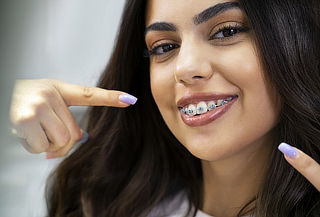 Instalación de Brackets Metálicos en Ambas Arcadas