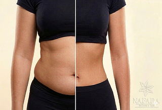 5 Sesiones Lipolaser + Cavitacion + Radiofecuencia + Drenaje