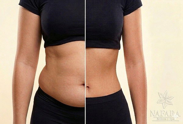 5 Sesiones Lipolaser + Cavitacion + Radiofecuencia + Drenaje