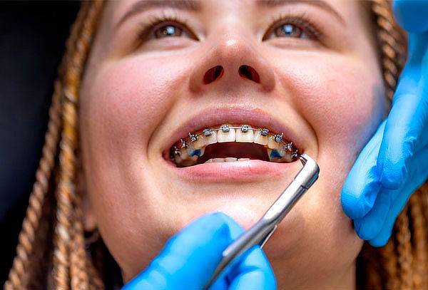 Instalación de Brackets Metálicos