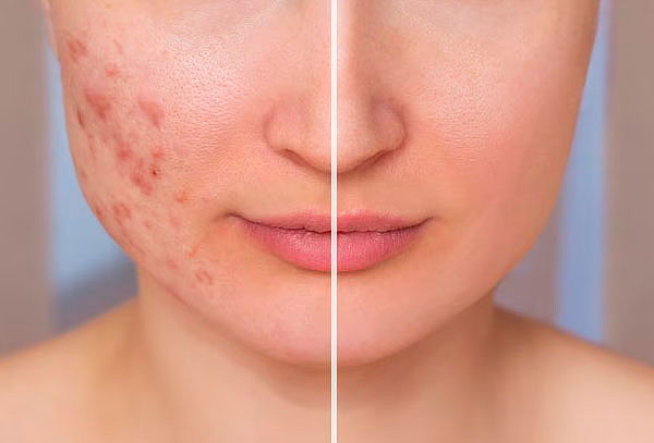 Facial profundo Antiacné o Despigmentante