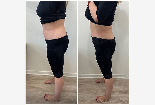 Body Prestige, Tratamiento reductivo en Perfect Body