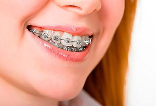 2x1 Brackets Mini + Radiografía +  Profilaxis