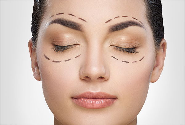 Blefaroplastia No Quirúrgica con Fibroblast