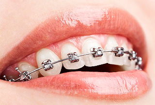 Brackets Inteligentes Mini Roth + Panorámica en Kennedy