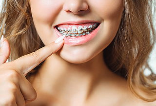 Brackets Mini Roth + Radiografía + Profilaxis en Kennedy 