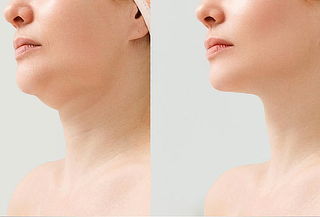 Lipopapada Estética + 2 Controles con Ultrasonido + Regalo