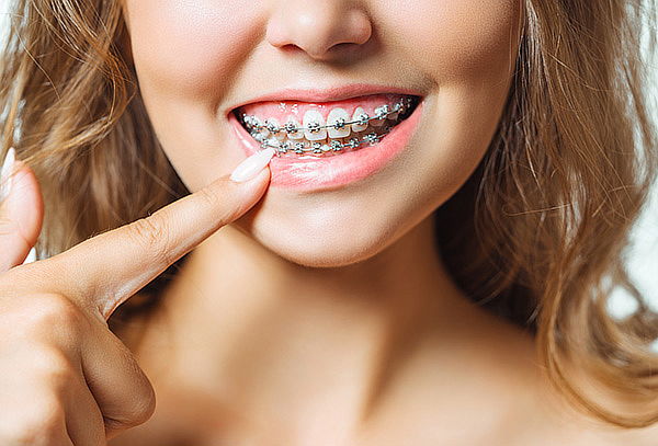 Brackets Roth + Radiografía + Limpieza en Puentelargo