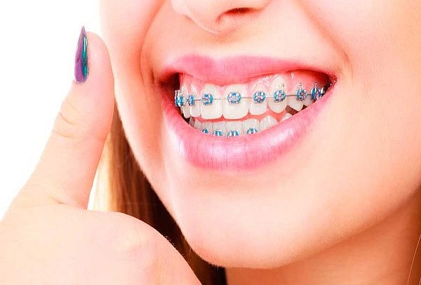 Valoración + Montaje de Brackets Mini Roth + Profilaxis
