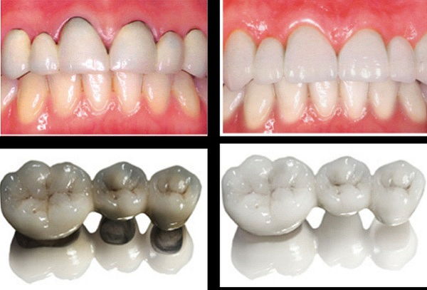 Corona en Zirconio de Alta Estética + Valoración
