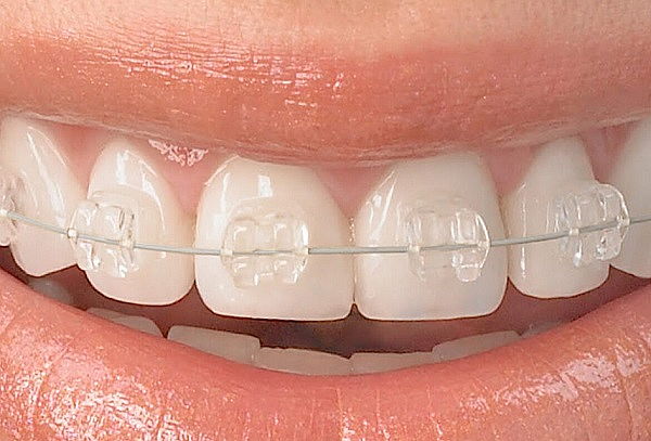Brackets Estéticos + Valoración + Profilaxis + Fotografias