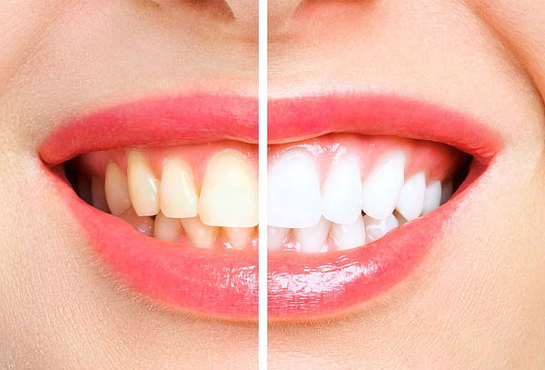 2 Sesiones de Blanqueamiento con Laser + Profilaxis  