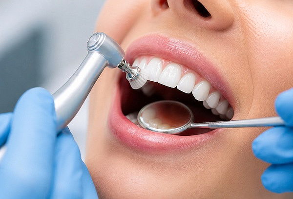 Valoración odontológica +  Detartraje + Profilaxis + Flúor