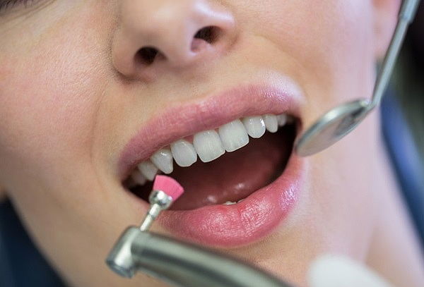 Brackets MBT Montaje Super e infer + Retenedor Fijo Inferior