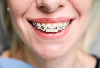 Montaje de Brackets Mini Roth + Valoración + Profilaxis