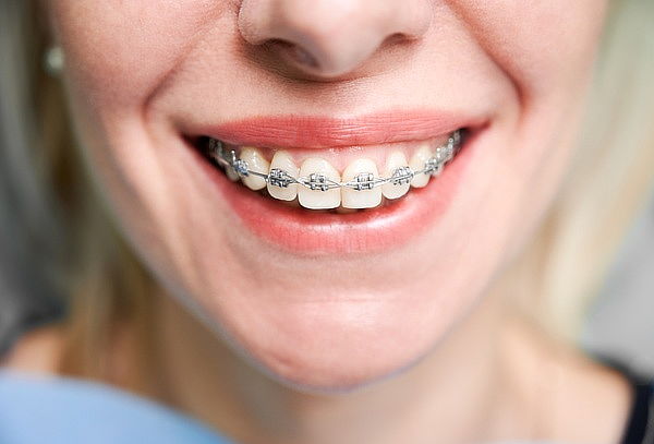 Montaje de Brackets Mini Roth + Valoración + Profilaxis