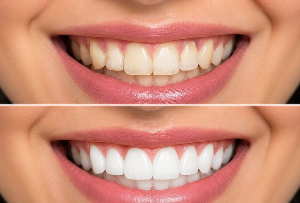2 Sesiones de Blanqueamiento + Profilaxis + Flúor