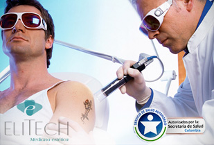 Sin Tatuajes con Laser