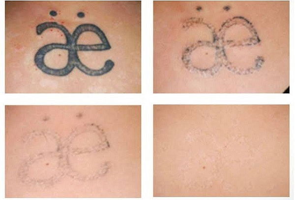 2x1 Retiro de tatuajes con picolaser 