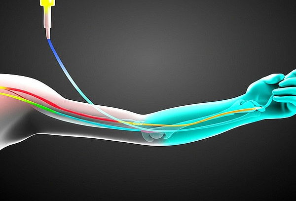 Terapia Neural Avanzada - Contra el dolor crónico