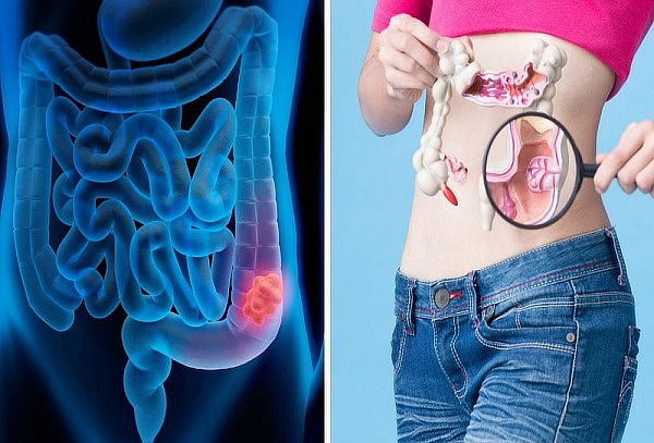 Remodelacion gastointestinal, recupera tu salud digestiva.