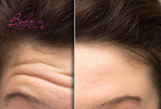 Toxina Botulínica + Limpieza facial + Bebida de cortesía