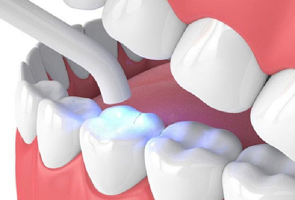 Resinas Esteticas + Desinfección con Ozono