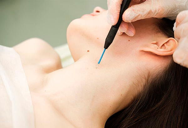 Eliminación de hasta 10 Verrugas con Plasma Fibroblast