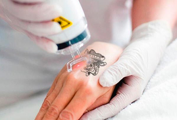 Eliminación de tatuajes o cicatrices con láser YAG