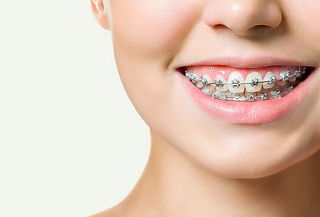 Corrige, Alinea y Transforma tu Sonrisa con Brackets